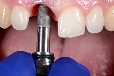 Tipos de prótesis dentales y sus beneficios