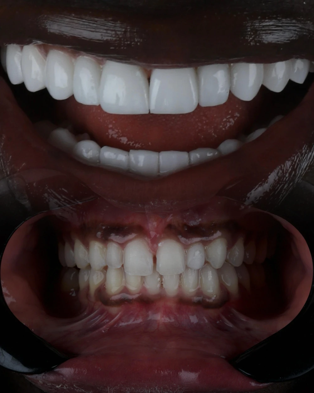 Porcelain veneers smile