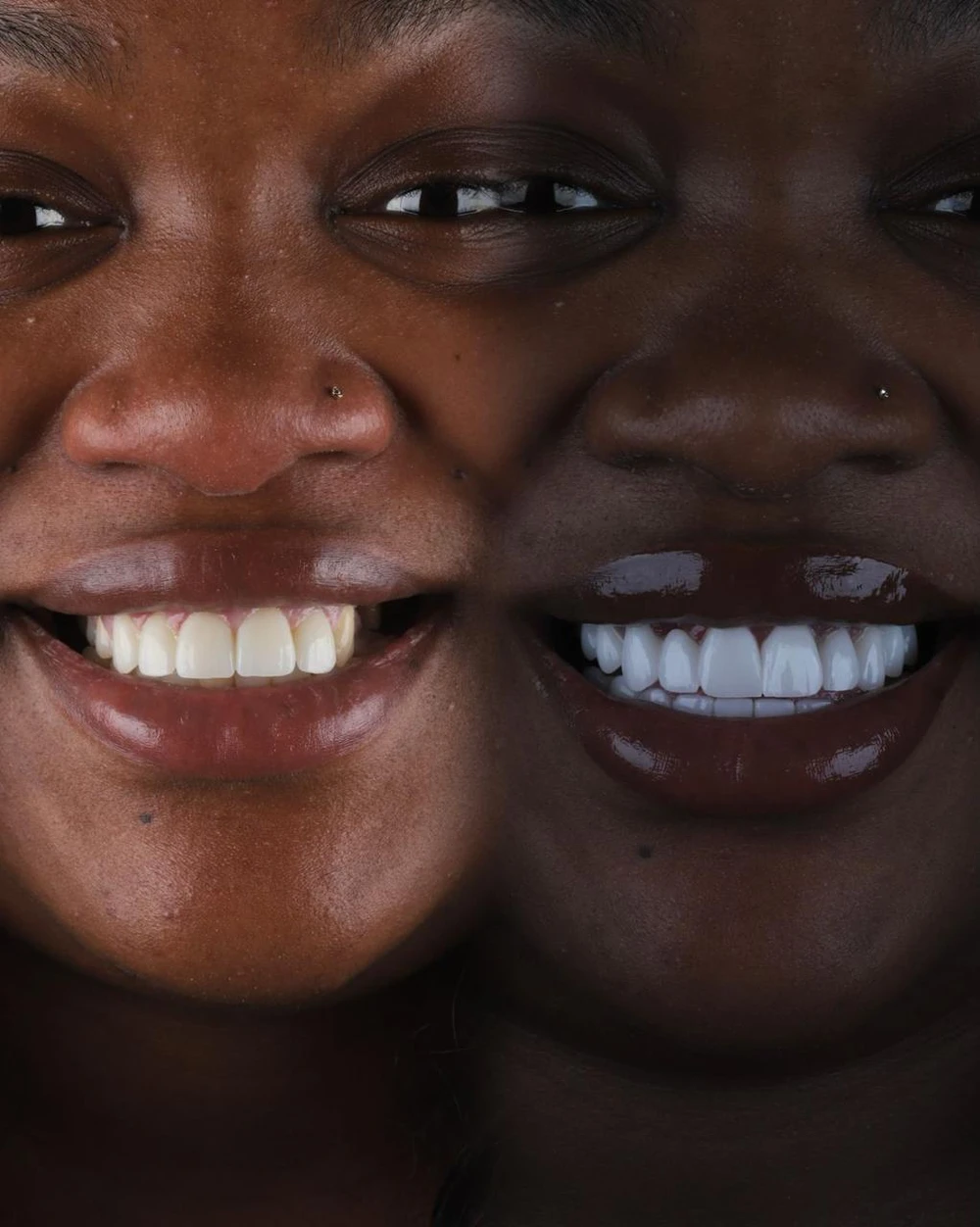 Porcelain veneers after placement