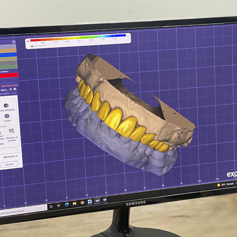 Digital design of dental crowns in the clinic's lab