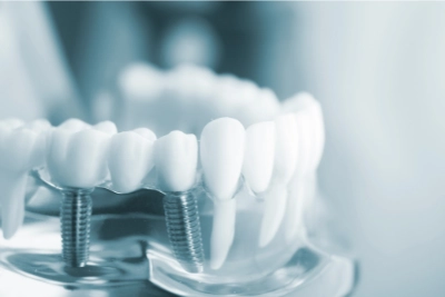 Fijas o removibles las prótesis dentales te mejoran la vida 