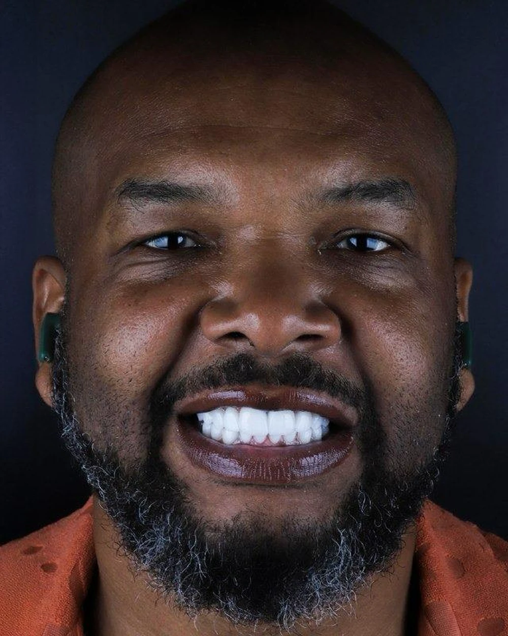 dr-victor-mendoza-veneers-10